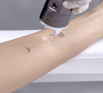 Laser Tattoo Removal