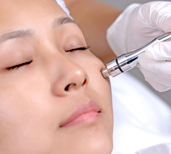 Microdermabrasion